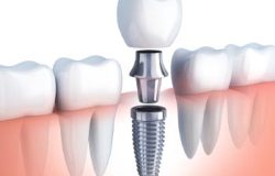 dental-implants